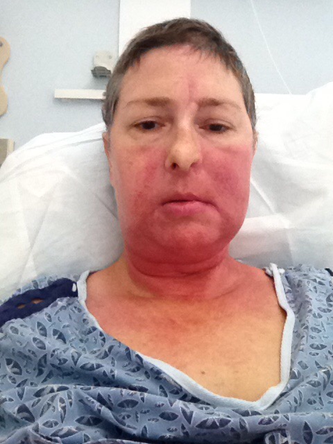 Cancer survivor and thriver Sue has severe radiation recall. It was drastically improved with Skinchanted CBD Massage & Body Oil